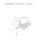 TWO-PART BONE CEMENT COMPOSITE CONTAINING PARTICLES IN A NON-UNIFORM SPATIAL DISTRIBUTION AND DEVICES FOR IMPLEMENTATION diagram and image