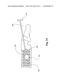 TWO-PART BONE CEMENT COMPOSITE CONTAINING PARTICLES IN A NON-UNIFORM SPATIAL DISTRIBUTION AND DEVICES FOR IMPLEMENTATION diagram and image