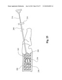 TWO-PART BONE CEMENT COMPOSITE CONTAINING PARTICLES IN A NON-UNIFORM SPATIAL DISTRIBUTION AND DEVICES FOR IMPLEMENTATION diagram and image