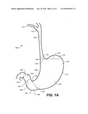 DEVICES, METHODS, AND KITS FOR GASTROINTESTINAL PROCEDURES diagram and image