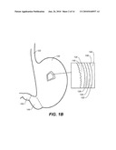 DEVICES, METHODS, AND KITS FOR GASTROINTESTINAL PROCEDURES diagram and image