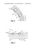 DEVICES, METHODS, AND KITS FOR GASTROINTESTINAL PROCEDURES diagram and image