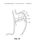 DEVICES, METHODS, AND KITS FOR GASTROINTESTINAL PROCEDURES diagram and image