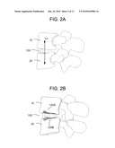 Insertion tool for Inter-body Vertebral Prosthetic Device With Self-Deploying Screws diagram and image