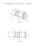 LOW PROFILE NON-SYMMETRICAL STENT diagram and image