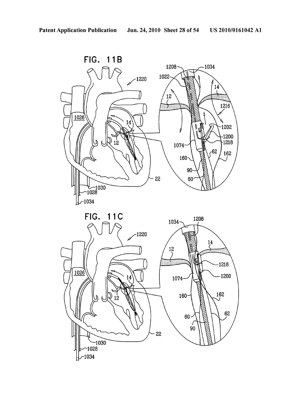 IMPLANTATION OF REPAIR CHORDS IN THE HEART - diagram, schematic, and image 29