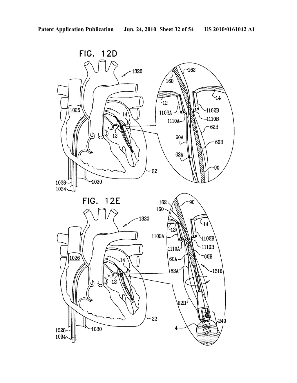 IMPLANTATION OF REPAIR CHORDS IN THE HEART - diagram, schematic, and image 33