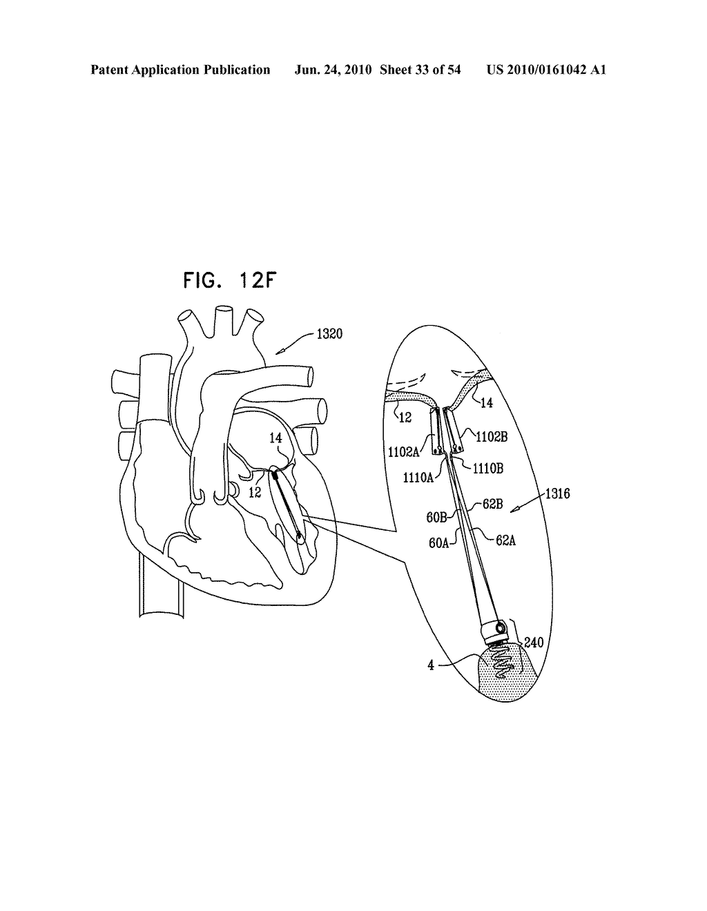 IMPLANTATION OF REPAIR CHORDS IN THE HEART - diagram, schematic, and image 34