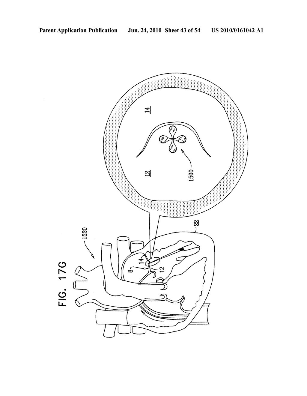 IMPLANTATION OF REPAIR CHORDS IN THE HEART - diagram, schematic, and image 44