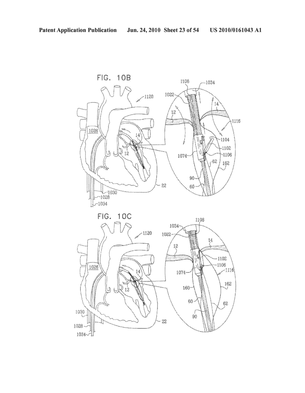 IMPLANTATION OF REPAIR CHORDS IN THE HEART - diagram, schematic, and image 24