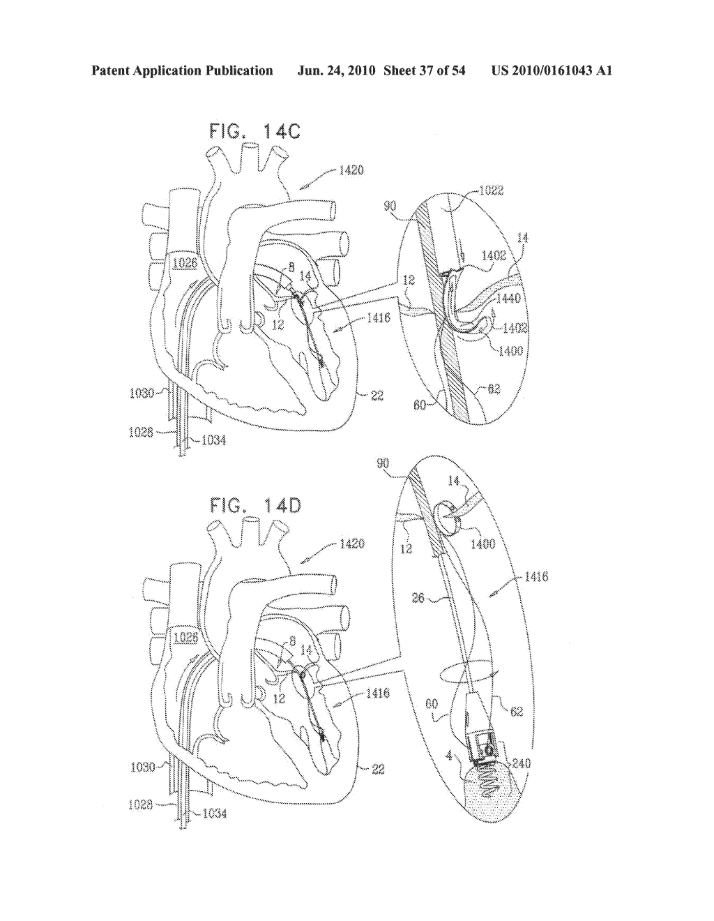 IMPLANTATION OF REPAIR CHORDS IN THE HEART - diagram, schematic, and image 38