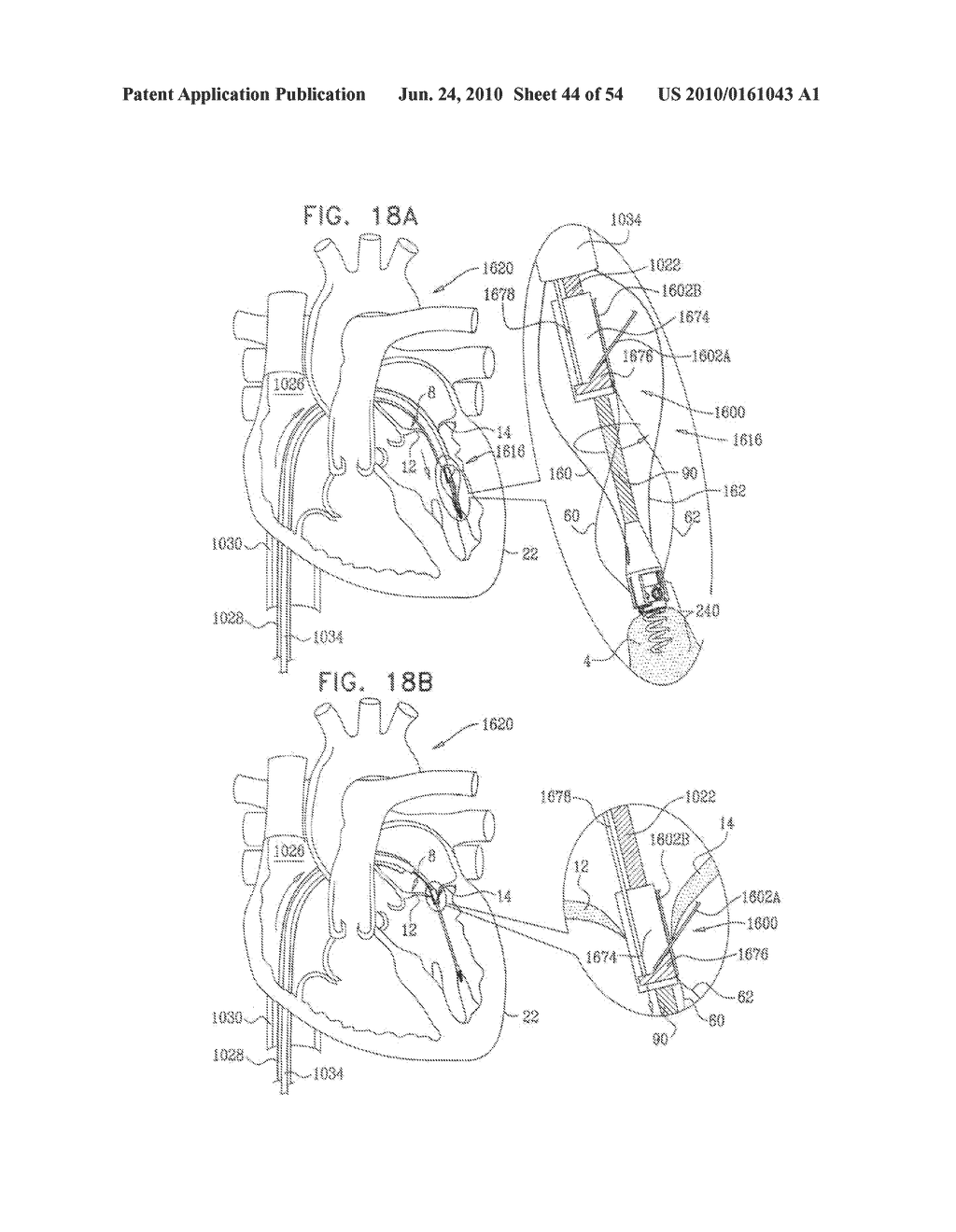 IMPLANTATION OF REPAIR CHORDS IN THE HEART - diagram, schematic, and image 45