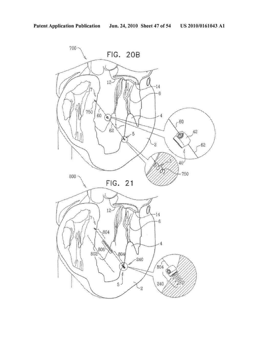 IMPLANTATION OF REPAIR CHORDS IN THE HEART - diagram, schematic, and image 48