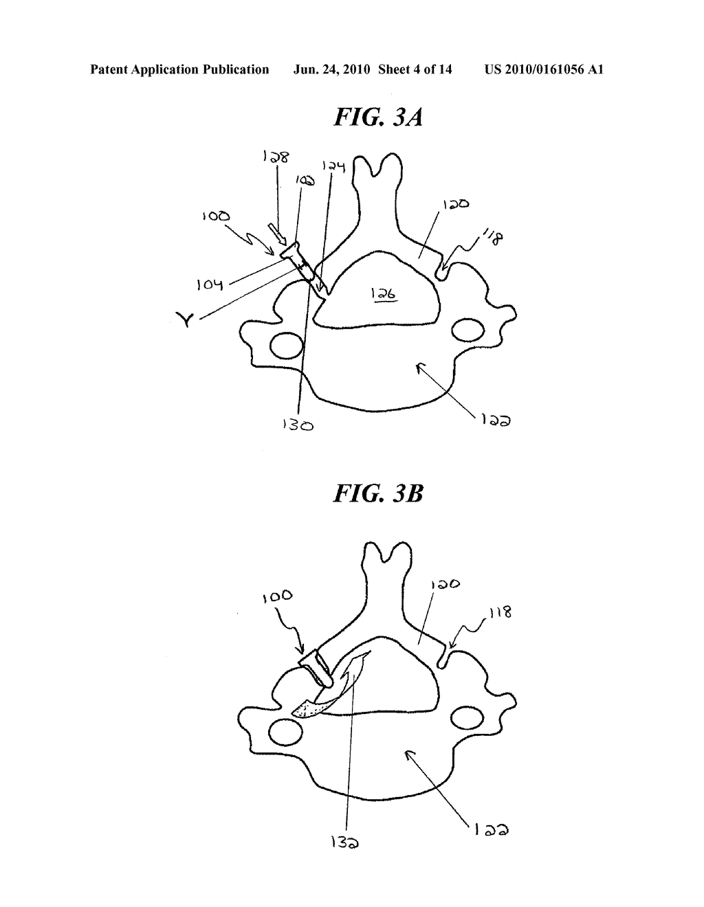 METHODS AND DEVICES FOR EXPANDING A SPINAL CANAL - diagram, schematic, and image 05