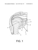 Shoulder Prosthesis with Vault-Filling Structure having Bone-Sparing Configuration diagram and image