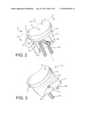 Shoulder Prosthesis with Vault-Filling Structure having Bone-Sparing Configuration diagram and image