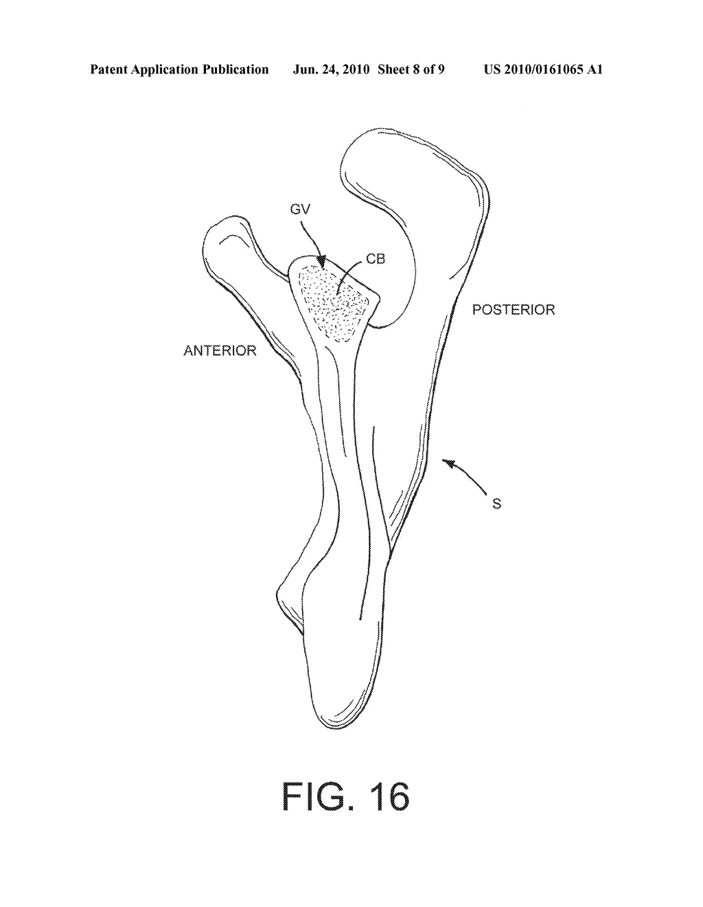 Shoulder Prosthesis with Vault-Filling Structure having Bone-Sparing Configuration - diagram, schematic, and image 09