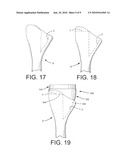 Shoulder Prosthesis with Vault-Filling Structure having Bone-Sparing Configuration diagram and image