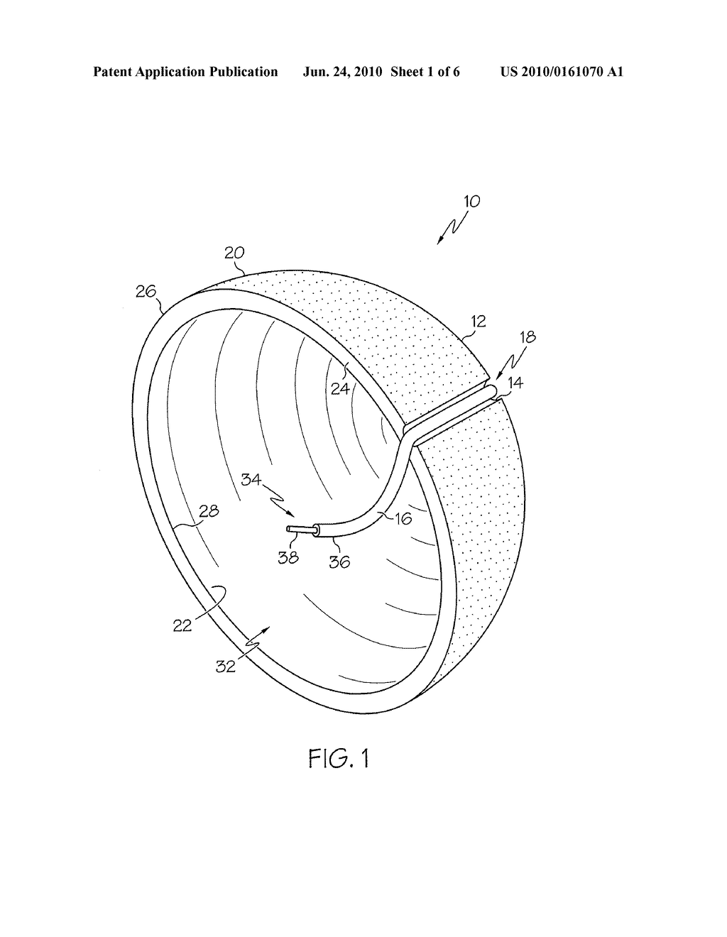 ORTHOPAEDIC PROSTHESIS HAVING A SEATING INDICATOR - diagram, schematic, and image 02