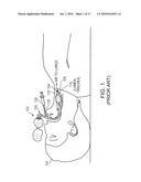 Methods and apparatus for safe application of an intubation device diagram and image