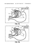 SELF-CONTAINED ORAL VENTILATION DEVICE diagram and image