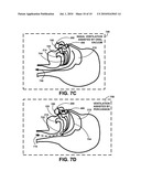 SELF-CONTAINED ORAL VENTILATION DEVICE diagram and image