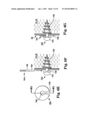 METHODS AND APPARATUS FOR SECURING A URETHRAL SLING TO A PUBIC BONE diagram and image