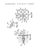 METHODS AND APPARATUS FOR SECURING A URETHRAL SLING TO A PUBIC BONE diagram and image