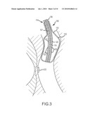 ABLATION SYSTEM WITH BLOOD LEAKAGE MINIMIZATION AND TISSUE PROTECTIVE CAPABILITIES diagram and image