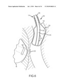 ABLATION SYSTEM WITH BLOOD LEAKAGE MINIMIZATION AND TISSUE PROTECTIVE CAPABILITIES diagram and image