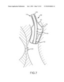 ABLATION SYSTEM WITH BLOOD LEAKAGE MINIMIZATION AND TISSUE PROTECTIVE CAPABILITIES diagram and image