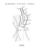 ABLATION SYSTEM WITH BLOOD LEAKAGE MINIMIZATION AND TISSUE PROTECTIVE CAPABILITIES diagram and image