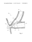 SEGMENTED BALLOON FOR CATHETER TIP DEFLECTION diagram and image