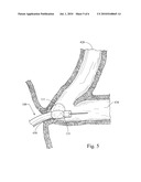 SEGMENTED BALLOON FOR CATHETER TIP DEFLECTION diagram and image