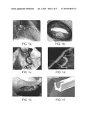 Tuned RF energy for selective treatment of atheroma and other target tissues and/or structures diagram and image