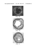 Tuned RF energy for selective treatment of atheroma and other target tissues and/or structures diagram and image