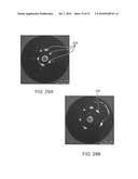 Tuned RF energy for selective treatment of atheroma and other target tissues and/or structures diagram and image