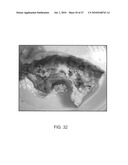 Tuned RF energy for selective treatment of atheroma and other target tissues and/or structures diagram and image