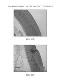 Tuned RF energy for selective treatment of atheroma and other target tissues and/or structures diagram and image