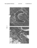 METHODS AND COMPOSITIONS FOR IMAGING ATHEROSCLEROTIC PLAQUES diagram and image