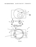 OCULAR RADIOSURGERY diagram and image