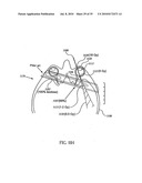 OCULAR RADIOSURGERY diagram and image