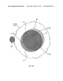 OCULAR RADIOSURGERY diagram and image