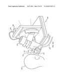 OCULAR RADIOSURGERY diagram and image