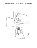 TREATMENT OF SOFT TISSUE INJURY USING HYALURONIC ACID AND BOTULINUM TOXIN diagram and image