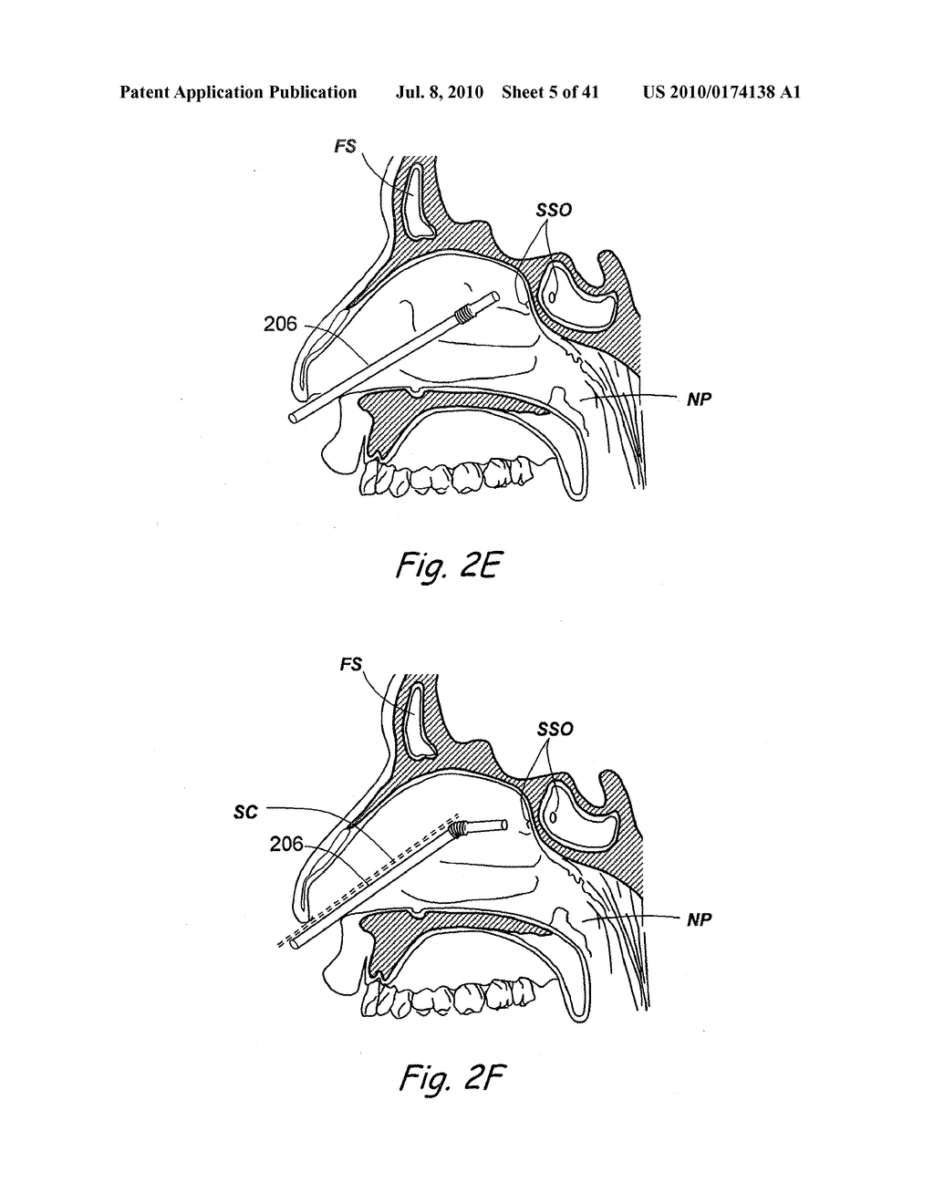 DEVICES, SYSTEMS AND METHODS USEABLE FOR TREATING SINUSITIS - diagram, schematic, and image 06