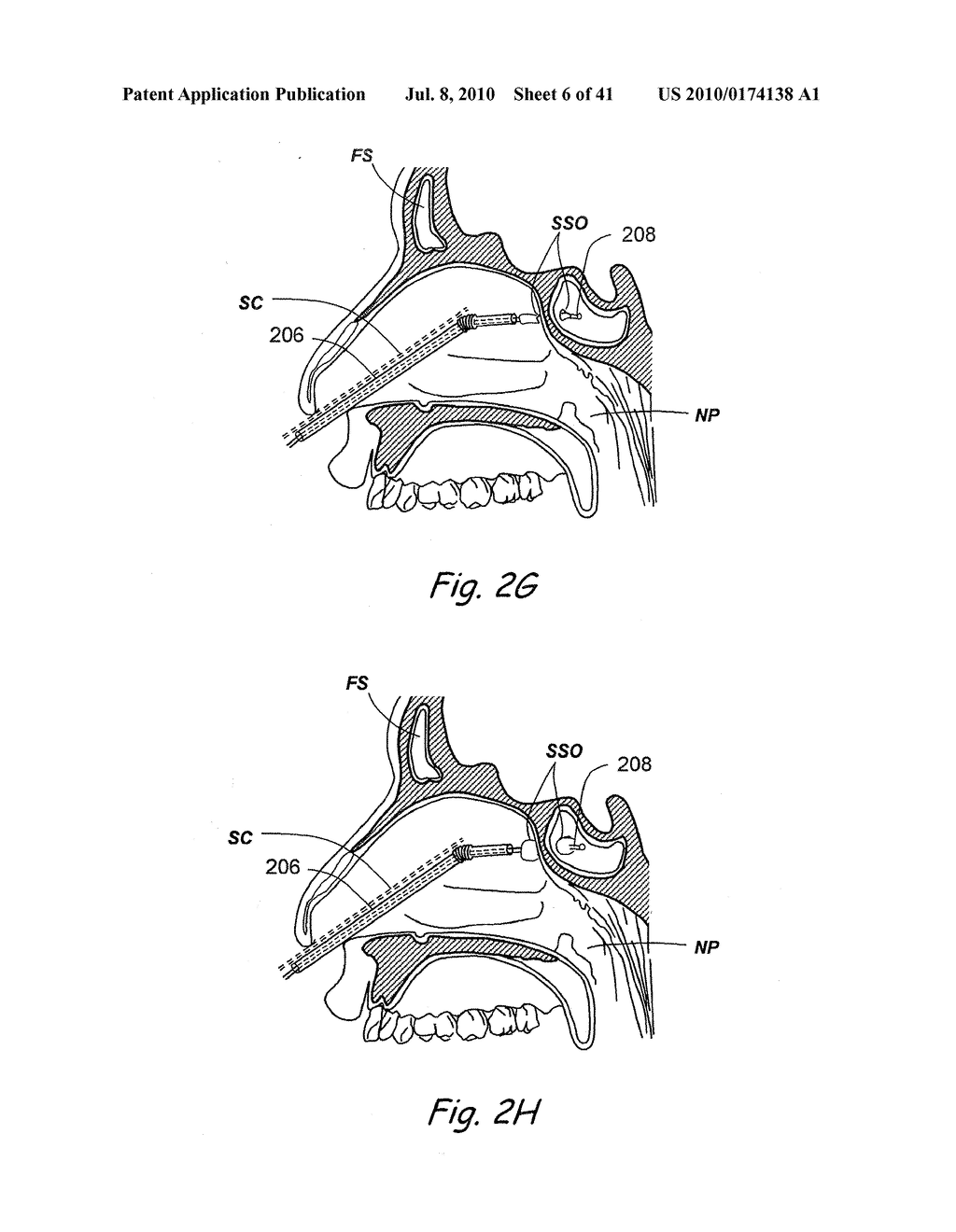 DEVICES, SYSTEMS AND METHODS USEABLE FOR TREATING SINUSITIS - diagram, schematic, and image 07