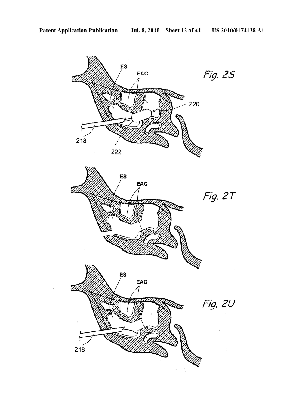 DEVICES, SYSTEMS AND METHODS USEABLE FOR TREATING SINUSITIS - diagram, schematic, and image 13