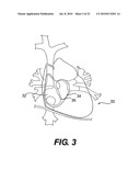 ANCHORED IMPLANTABLE PRESSURE MONITOR diagram and image