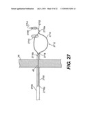 ANCHORED IMPLANTABLE PRESSURE MONITOR diagram and image